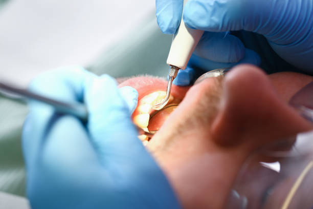 Best Emergency Root Canal Therapy in Spring Hope, NC